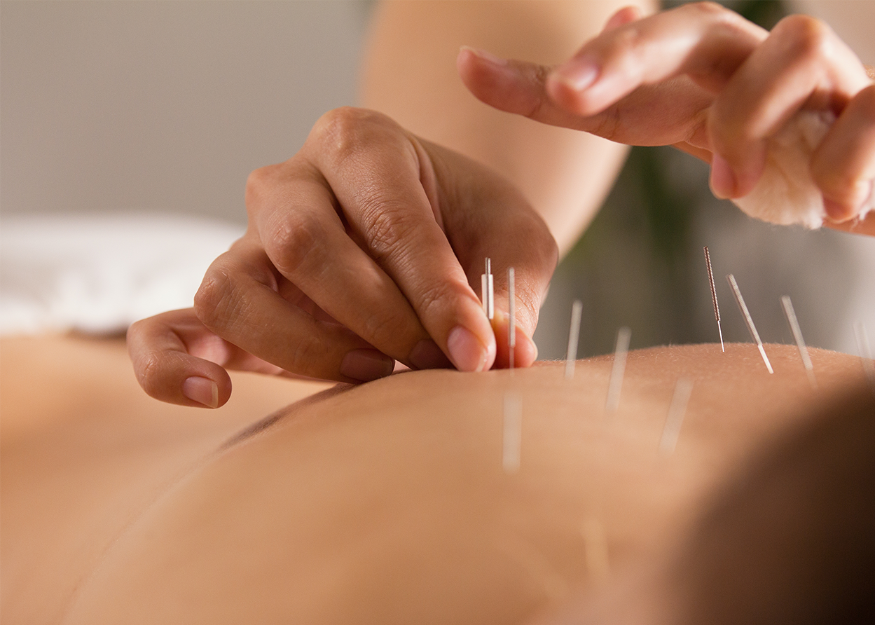 What is Dry Needling (IMS) and how is it different from acupuncture?