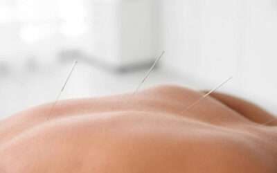 IMS vs. Acupuncture: What They Are and How They’re Different
