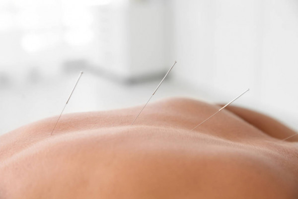 Photo of acupuncture needles in use